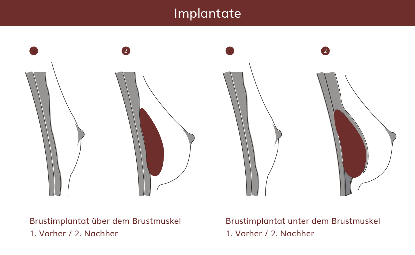 pro Brust Heidelberg Brustvergrößerung Methoden  