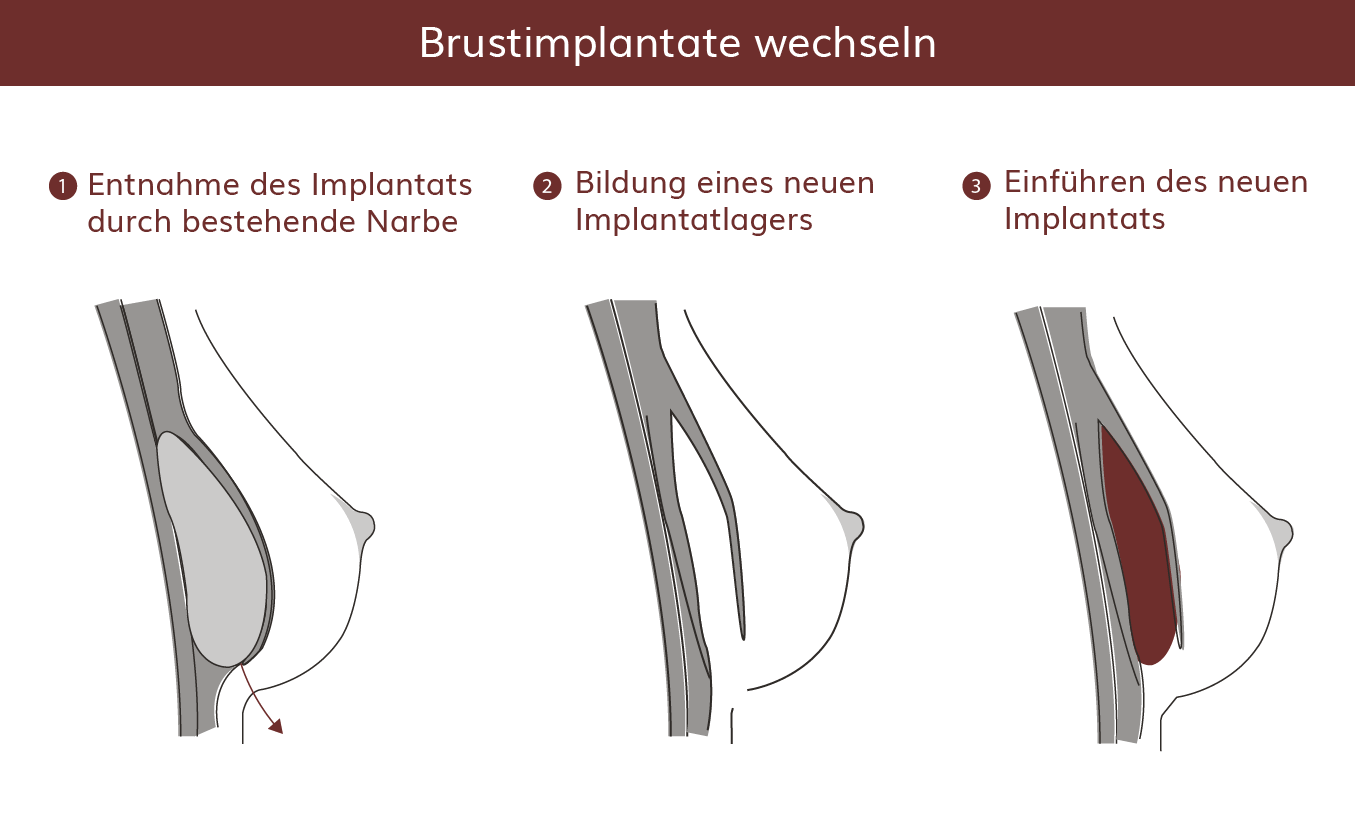 pro Brust Heidelberg Brustimplantate wechseln