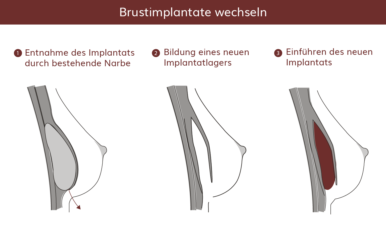 pro Brust Heidelberg Brustimplantate wechseln   