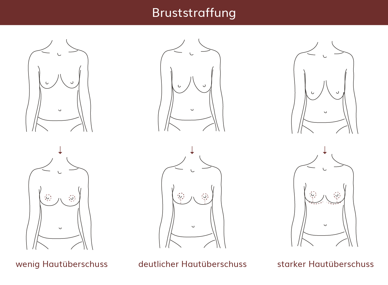 pro Brust Heidelberg Bruststraffung