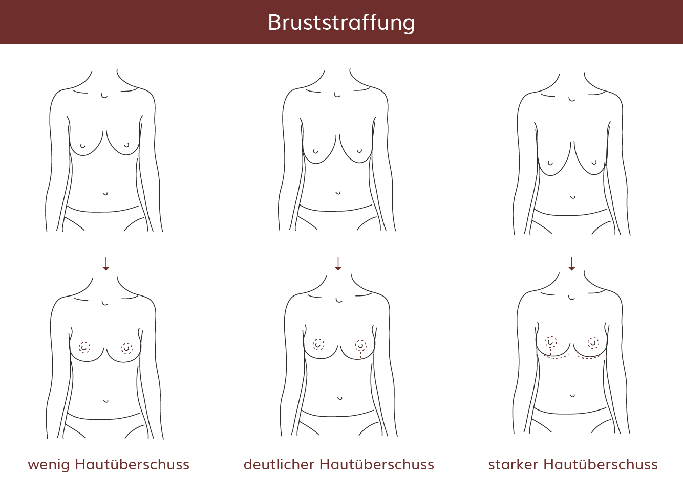 pro Brust Heidelberg Bruststraffung  