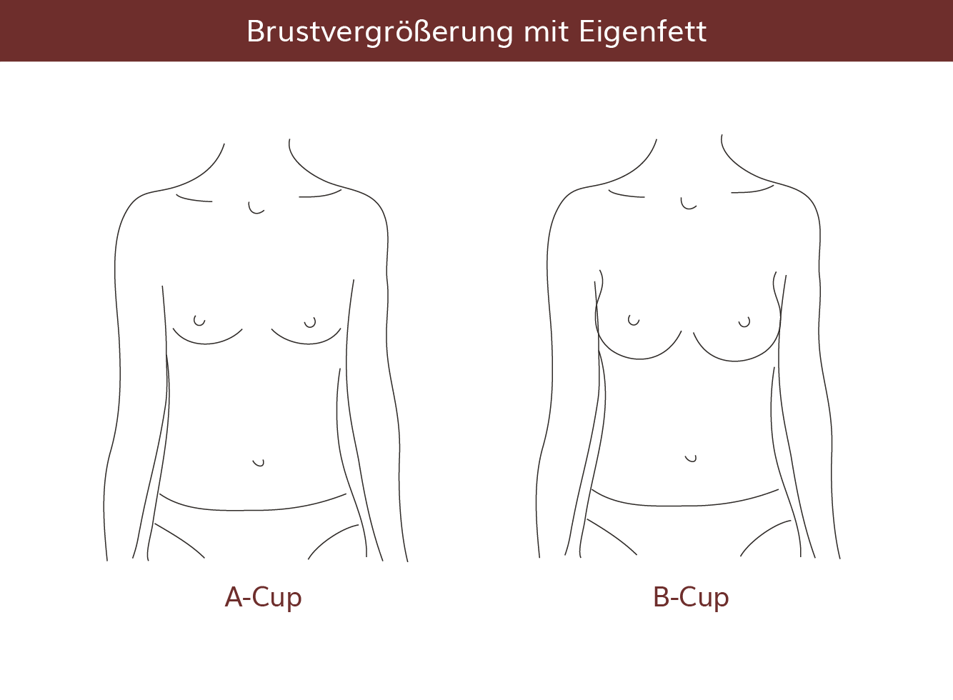 pro Brust Heidelberg Brustvergrößerung mit Eigenfett 