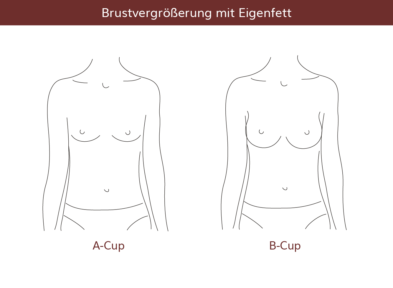 pro Brust Heidelberg Brustvergrößerung mit Eigenfett