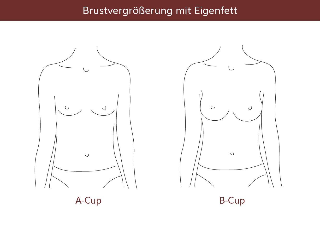 pro Brust Heidelberg Brustvergrößerung mit Eigenfett  