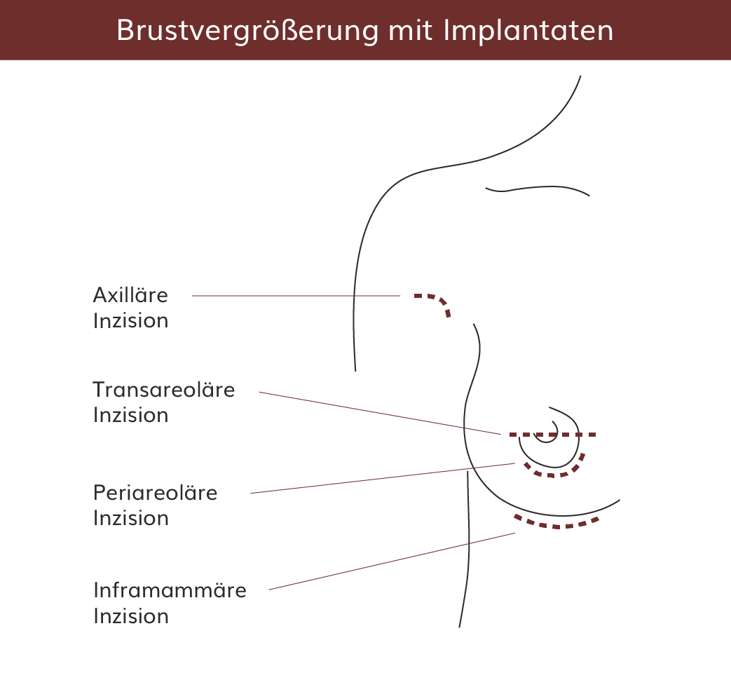 pro Brust Heidelberg Brustvergrößerung mit Implantaten