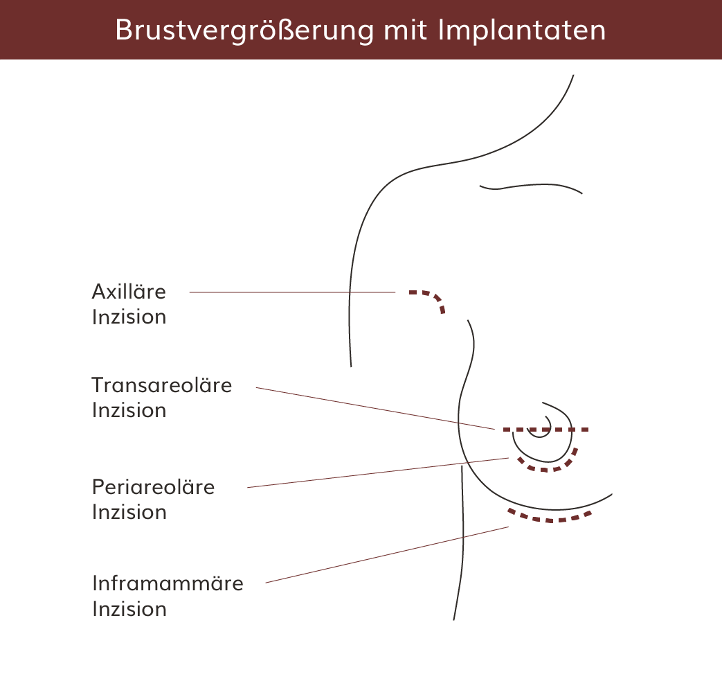 pro Brust Heidelberg Brustvergrößerung mit Implantaten  