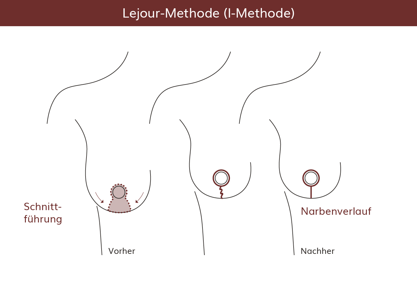l-methode-brustverkleinerung-narbenverlauf-heidelberg pro Brust Heidelberg Brustverkleinerung Lejour-Methode Narbenverlauf