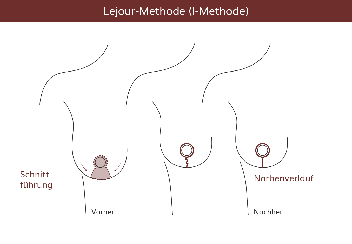 pro Brust Heidelberg Brustverkleinerung Lejour-Methode Narbenverlauf  