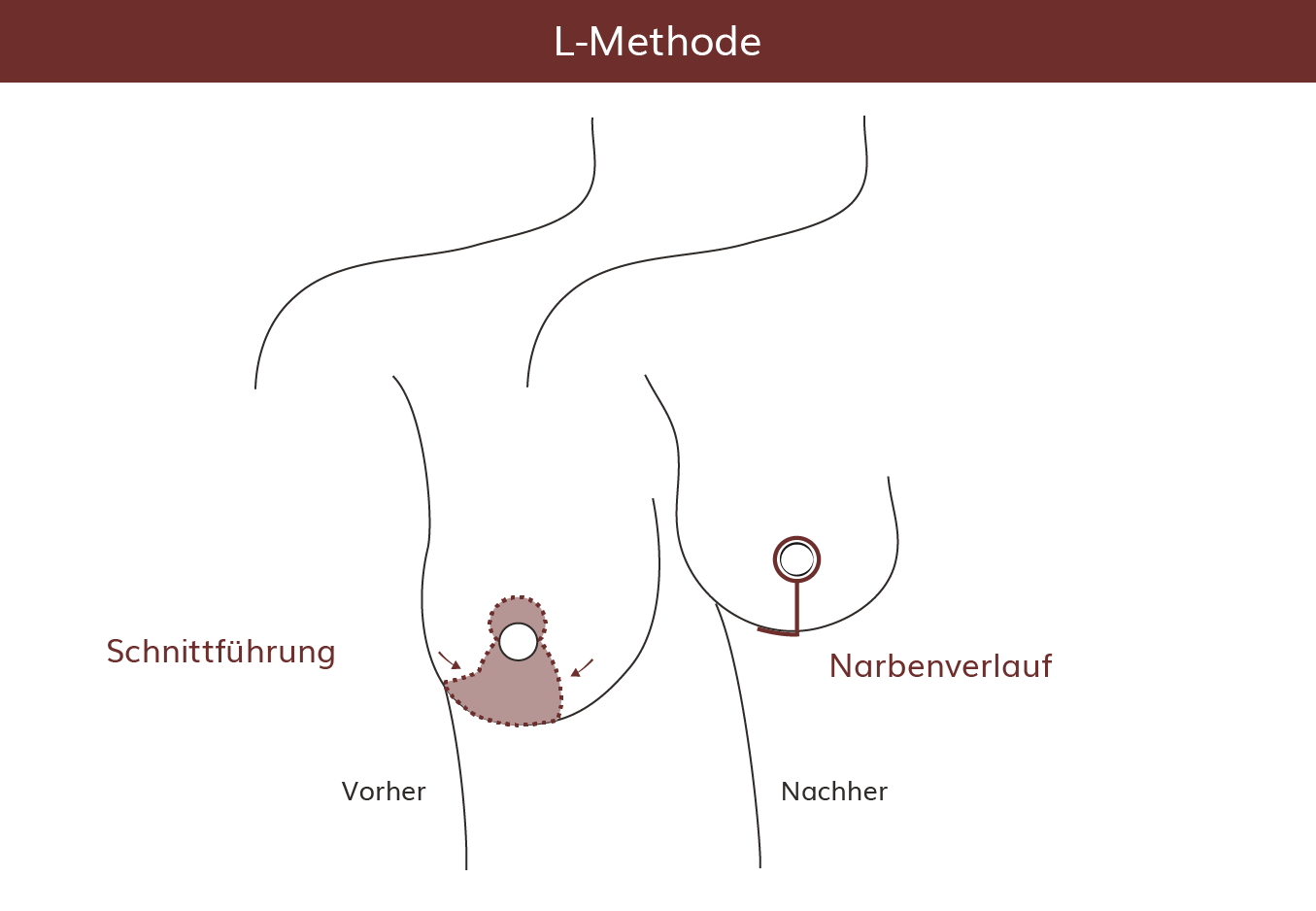 pro Brust Heidelberg Brustvergrößerung Lejour-Methode Verlauf 