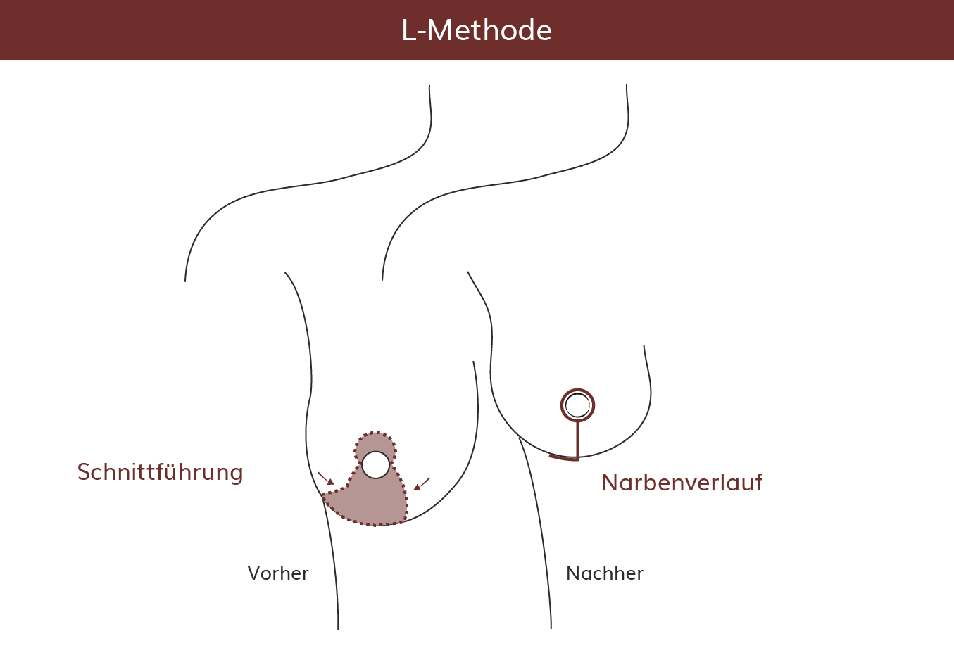 pro Brust Heidelberg Brustvergrößerung Lejour-Methode Verlauf