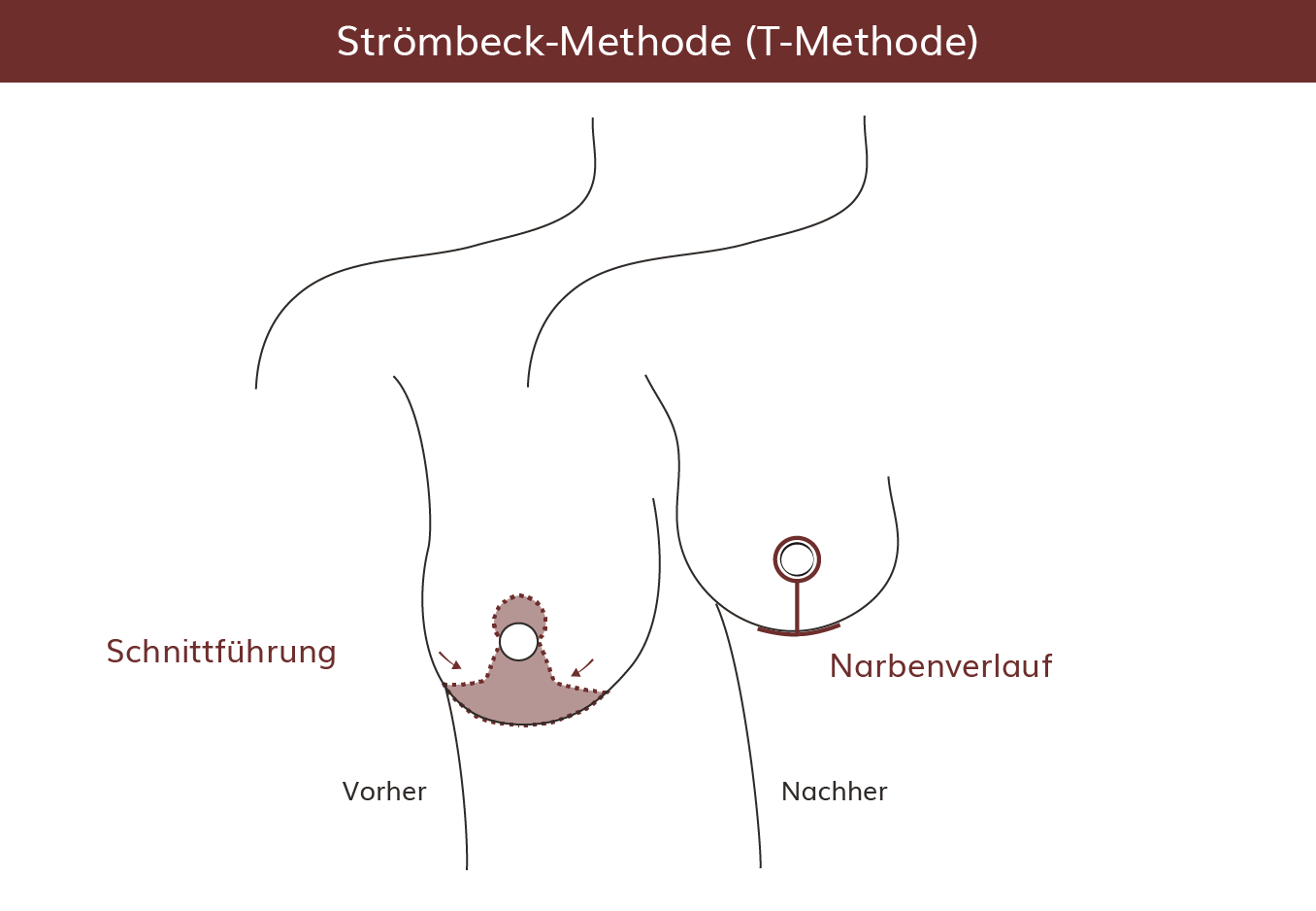 pro Brust Heidelberg Brustverkleinerung Strömbeck-Methoden 