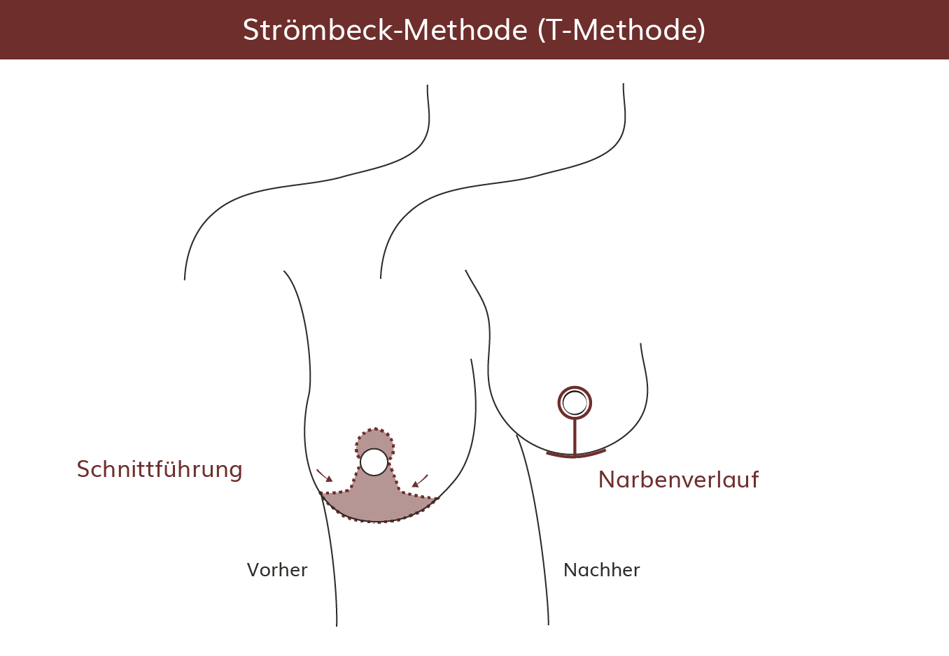 t-methode-brustverkleinerung-heidelberg pro Brust Heidelberg Brustverkleinerung Strömbeck-Methoden