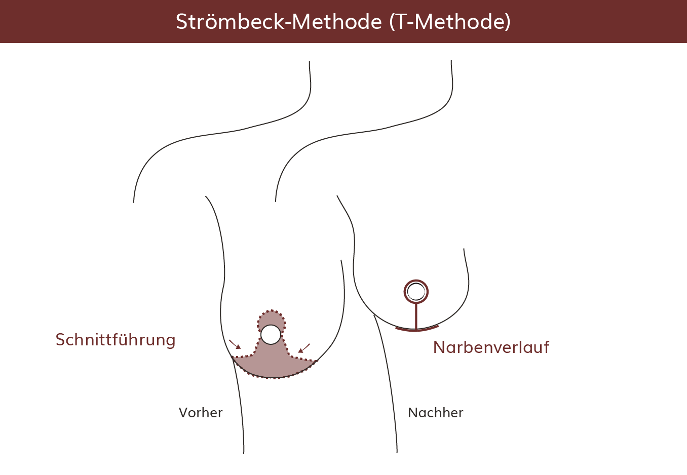 pro Brust Heidelberg Brustverkleinerung Strömbeck-Methoden  